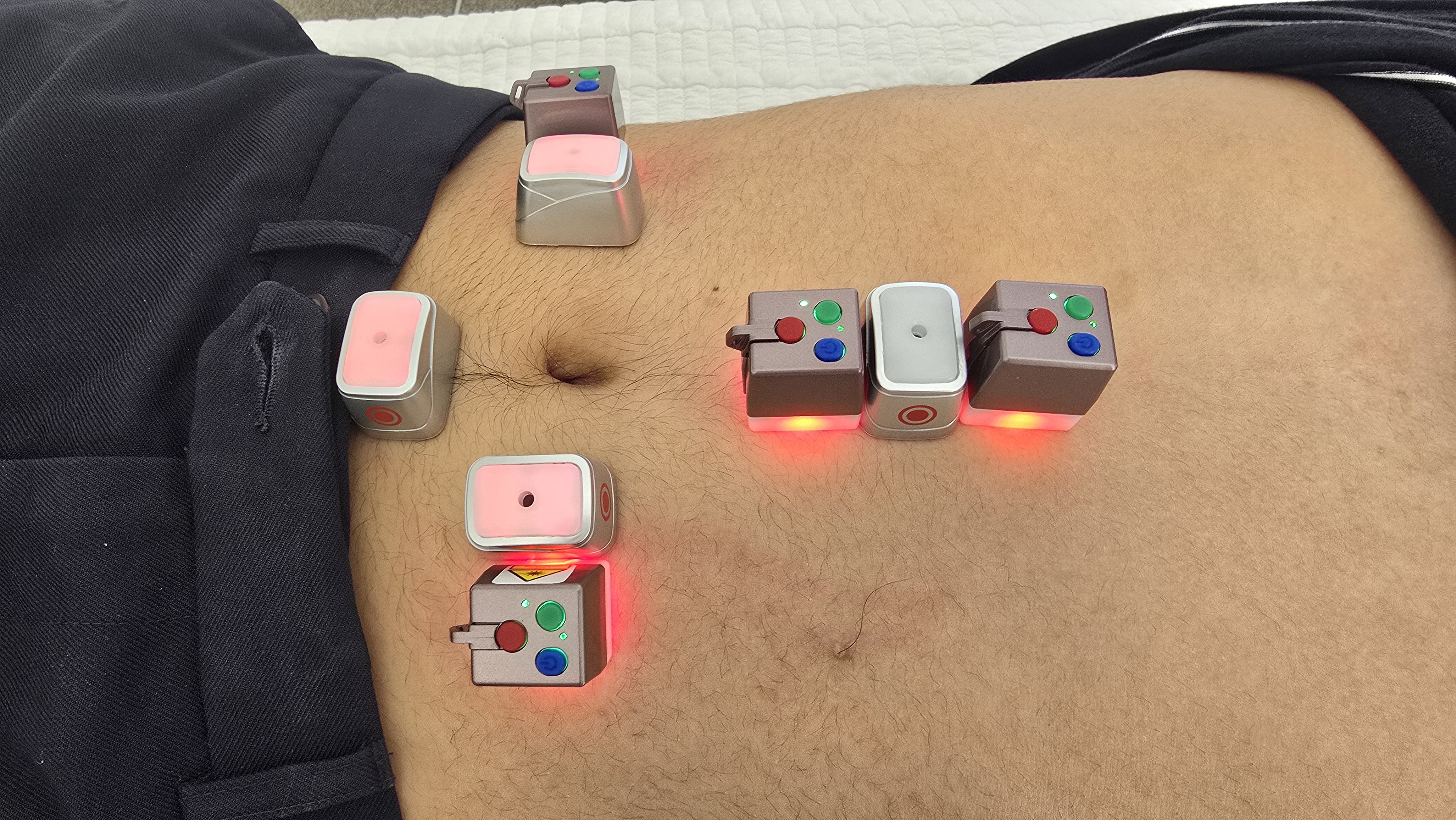 RootCare home-use device example on the abdomen