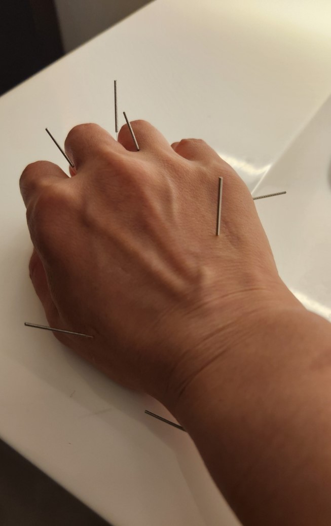 Classic acupuncture care option