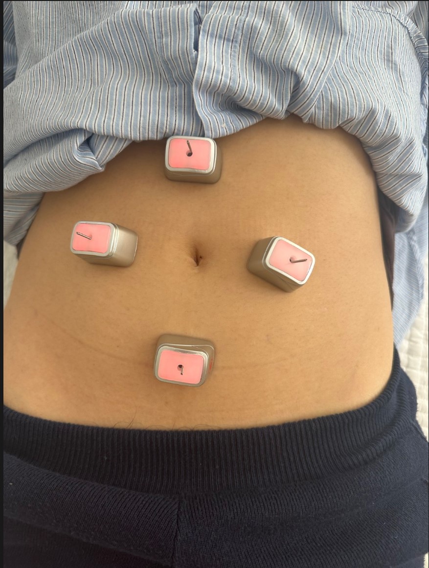 Electro moxa support option